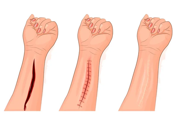 diabetes wound healing